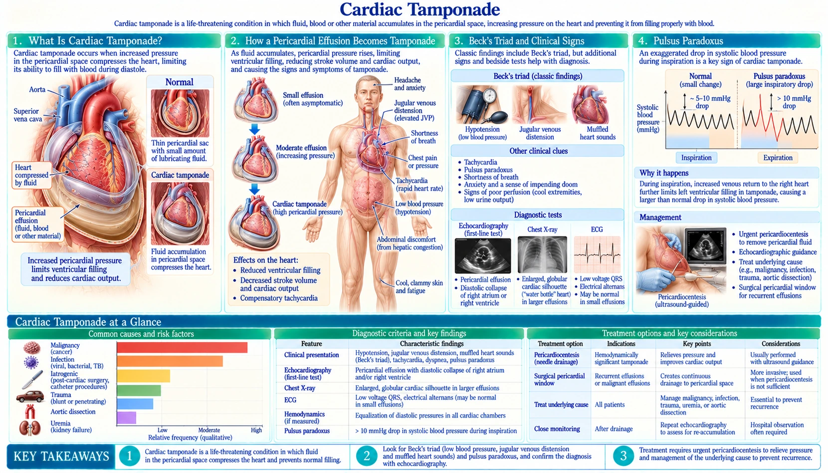 Cardiac Tamponade — scientific infographic poster