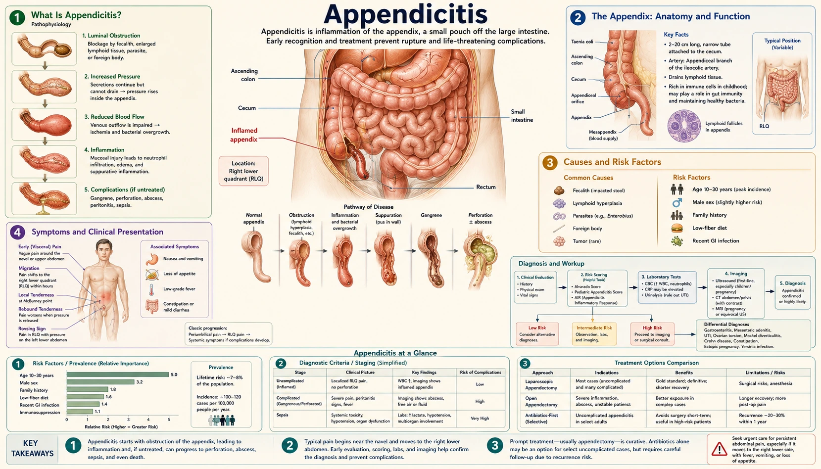 Appendicitis — scientific infographic poster