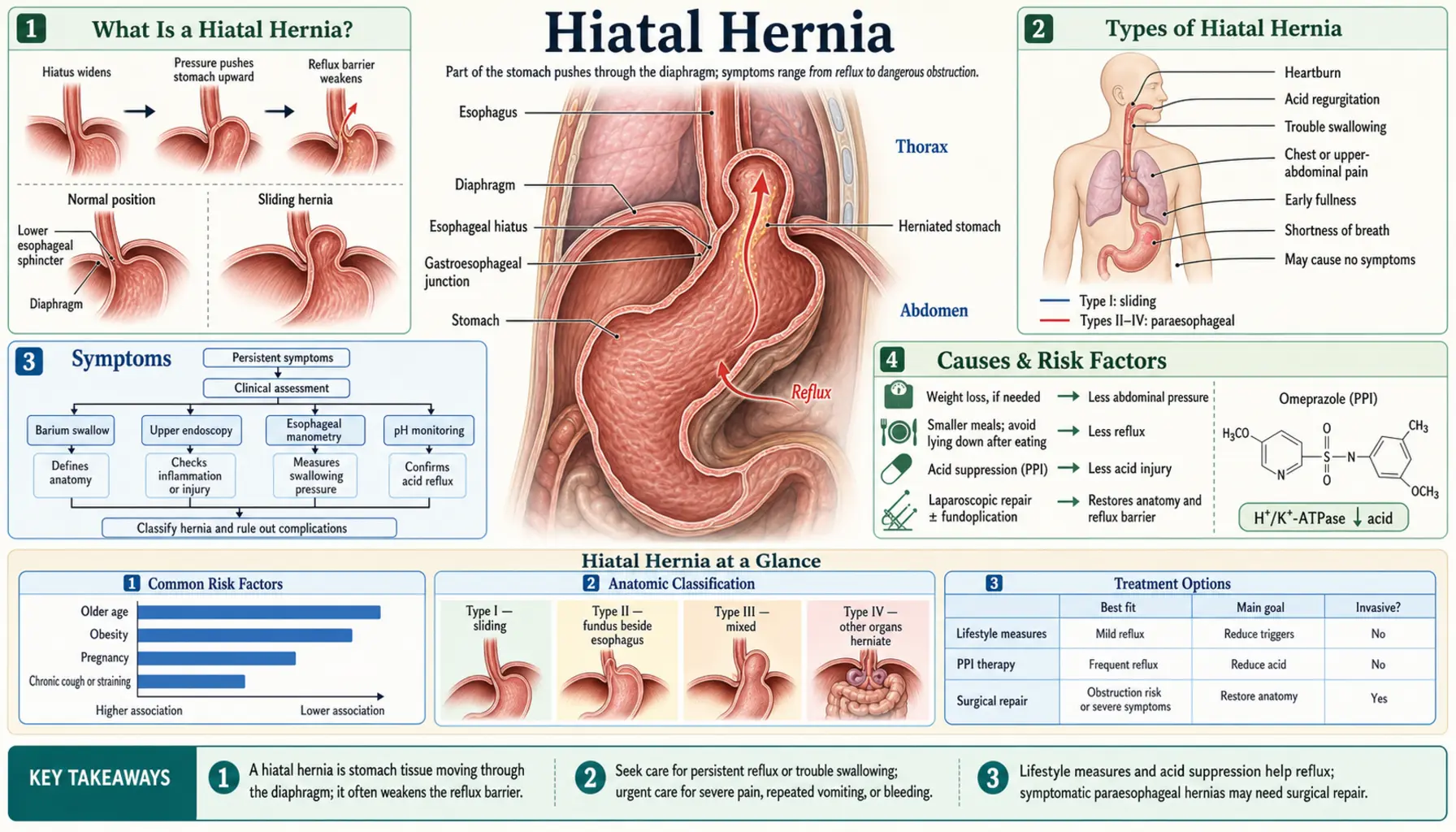 Hiatal Hernia — scientific infographic poster