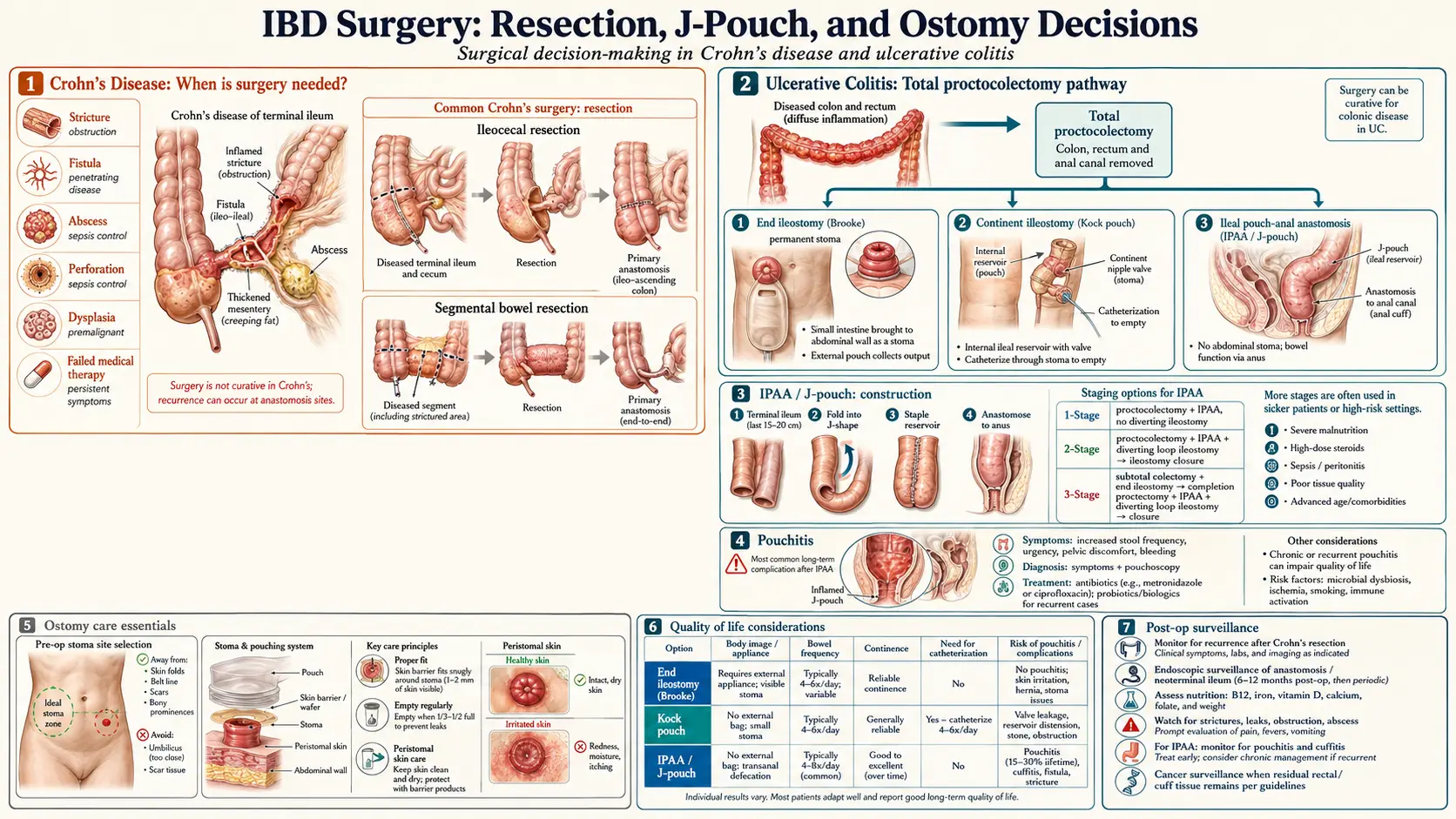 Surgery Decisions Resection J Pouch Ostomy — scientific infographic poster