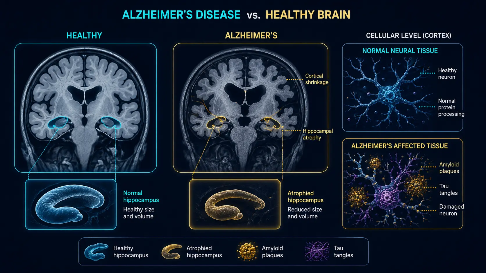 Alzheimer's vs healthy brain: amyloid plaques and tau tangles