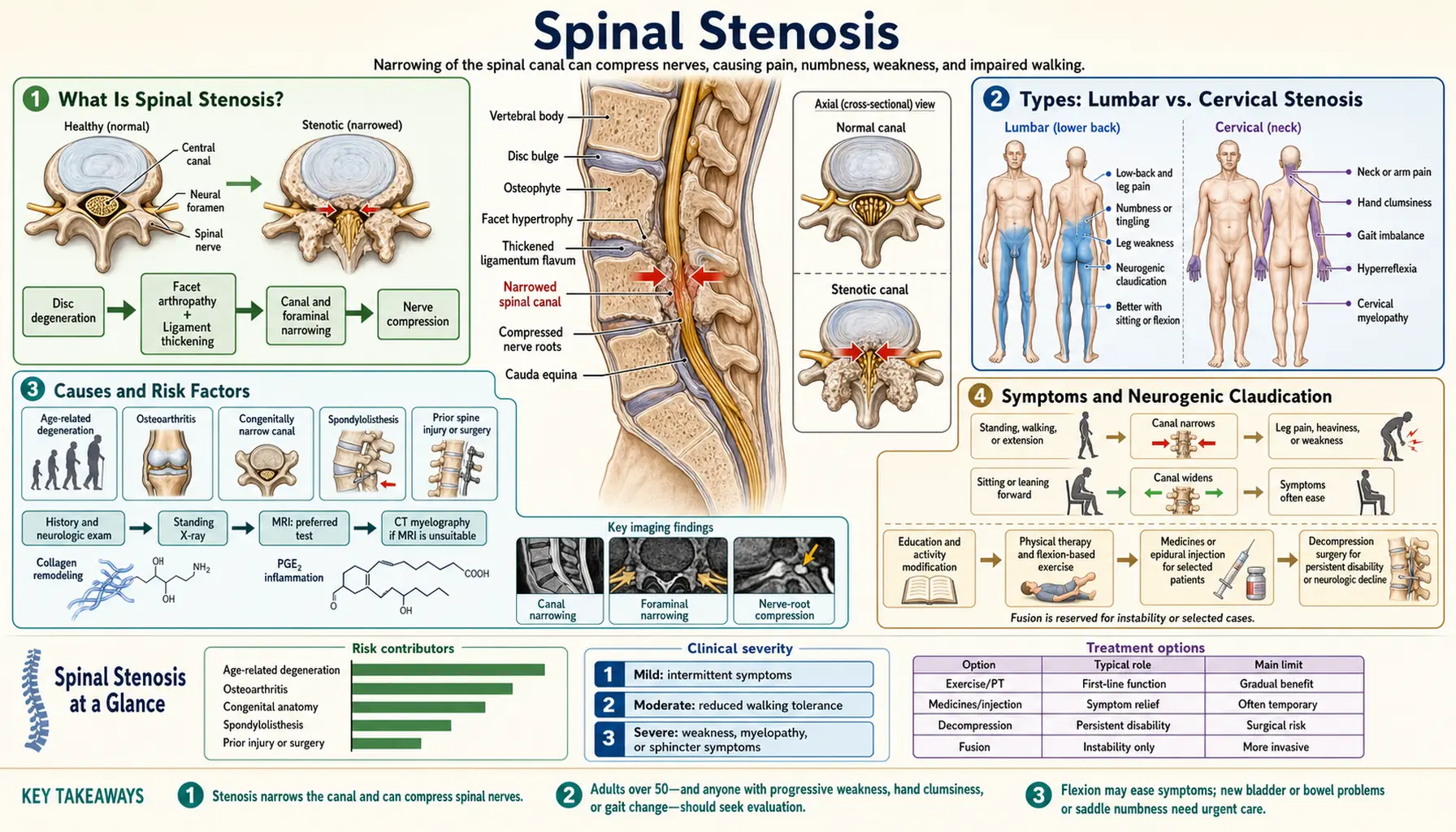 Spinal Stenosis — scientific infographic poster