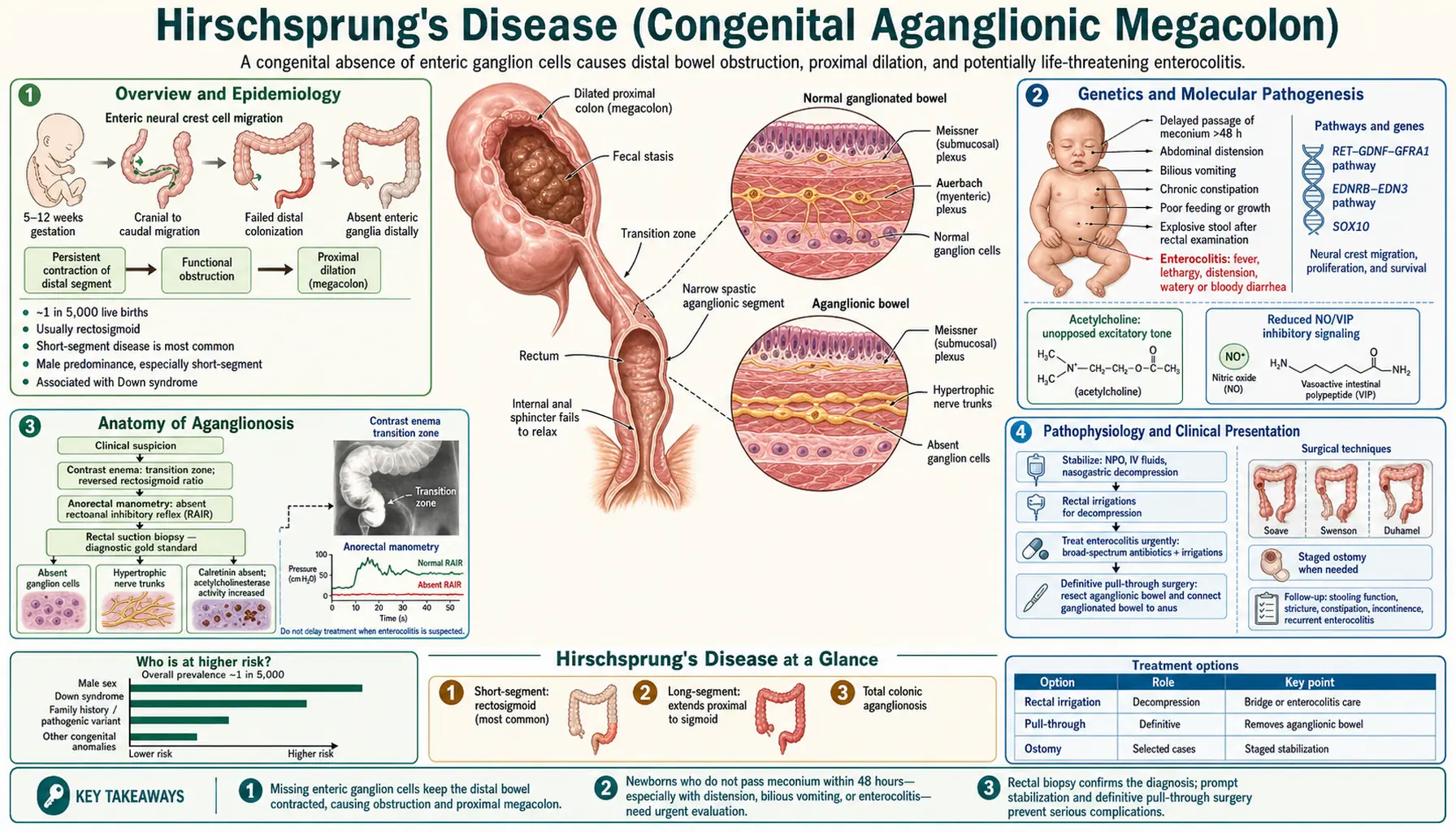 Hirschsprungs Disease — scientific infographic poster