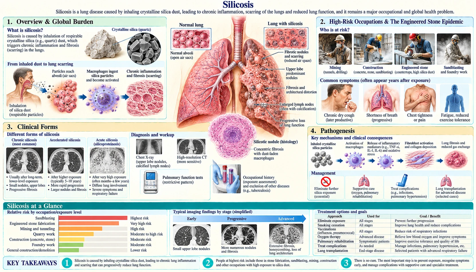 Silicosis — scientific infographic poster