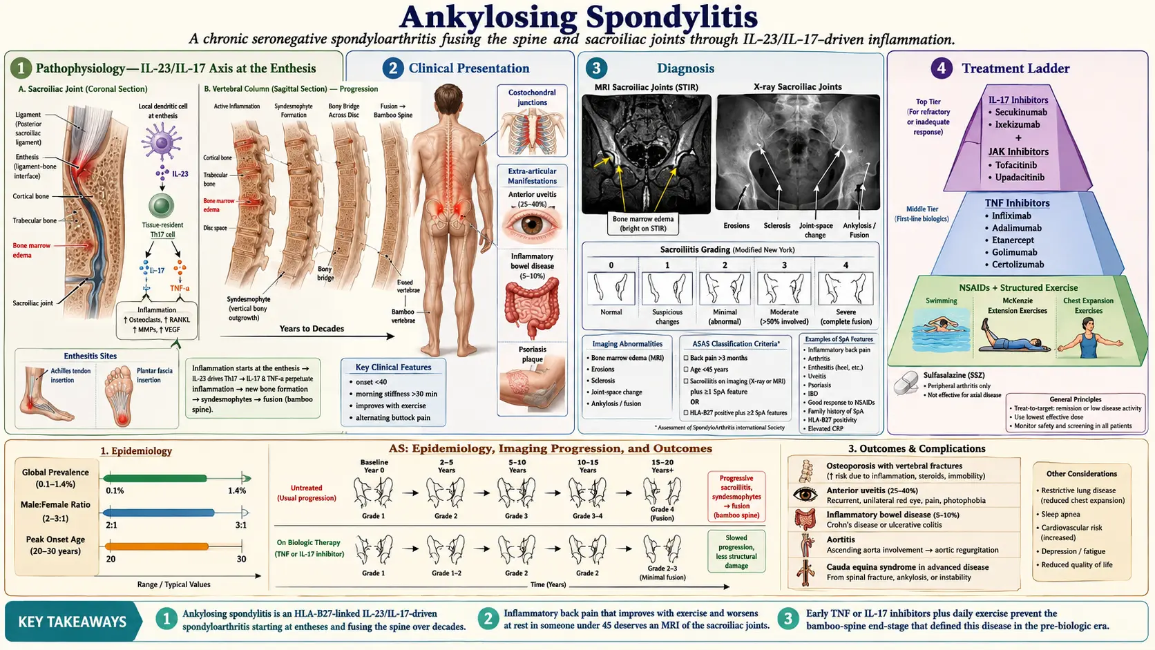 Ankylosing Spondylitis — scientific infographic poster
