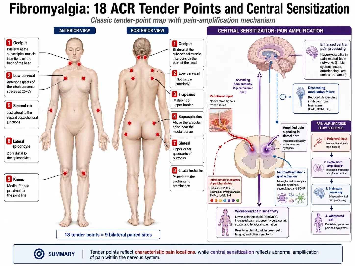 Fibromyalgia 18 ACR tender points body diagram with central sensitization mechanism