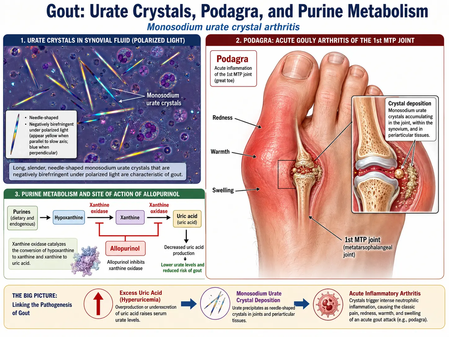 Gout uric acid crystals