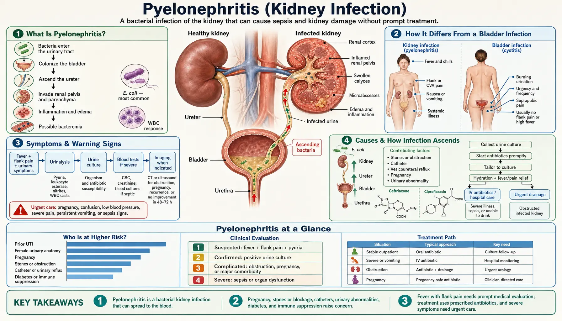 Pyelonephritis — scientific infographic poster