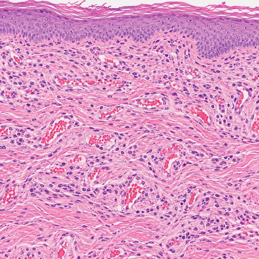 Healing skin tissue laying down new collagen