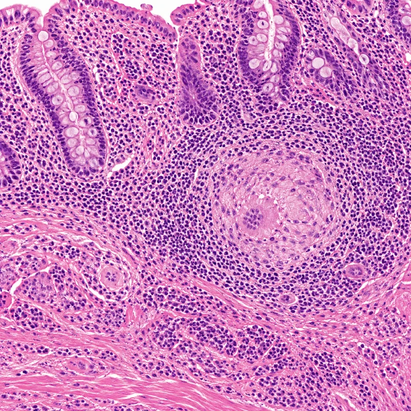 Crohn's disease inflammation in the bowel wall