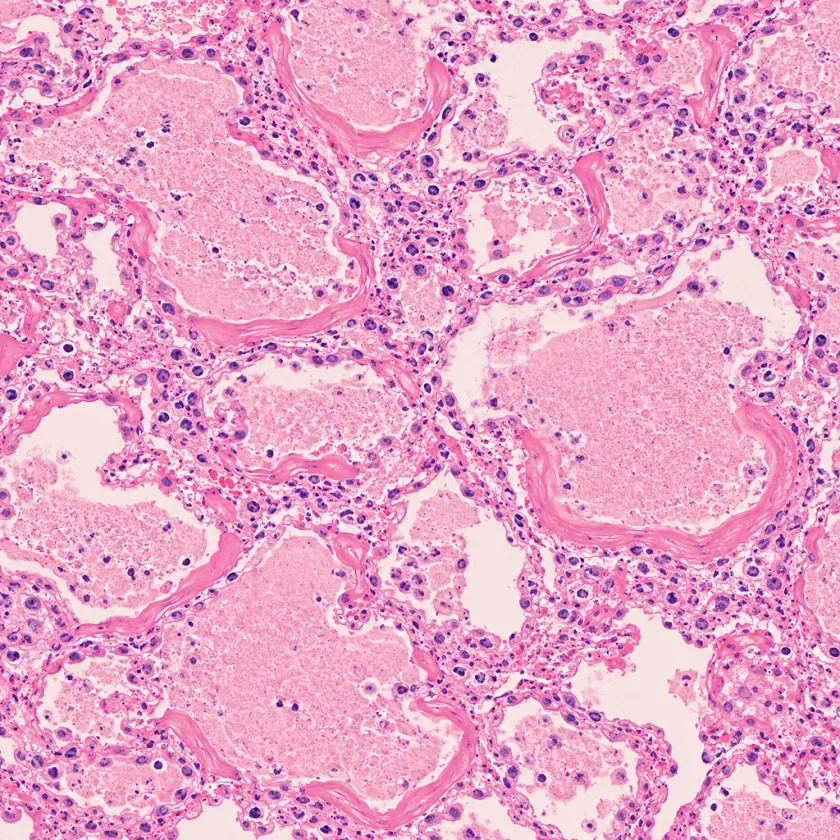 Fluid-filled lung tissue, as in perilla ketone poisoning of cattle