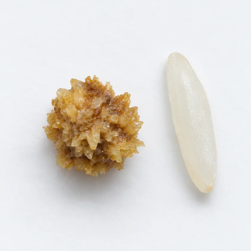 A calcium oxalate kidney stone