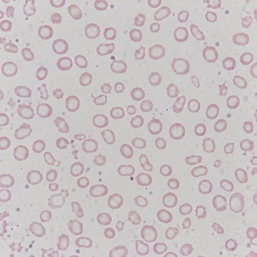 Pale small red cells seen in iron deficiency