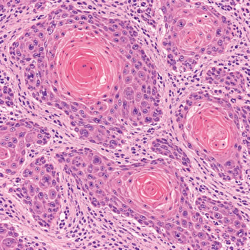 Oral squamous cell carcinoma in tissue