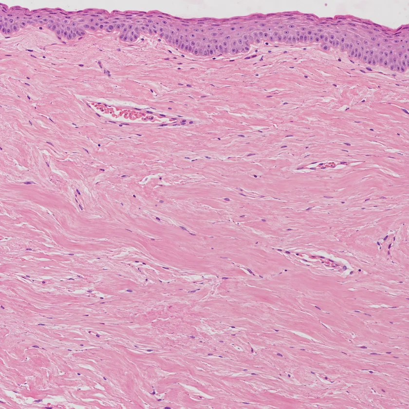 Advanced oral submucous fibrosis, dense scar-like collagen