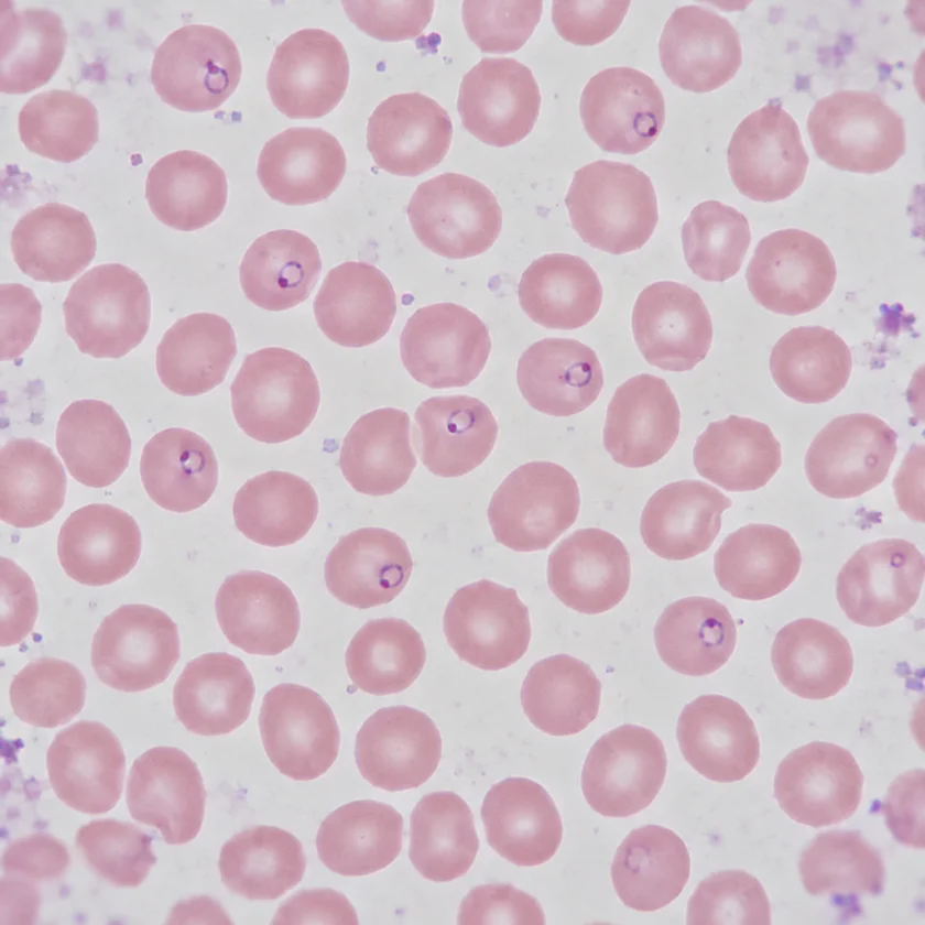 Malaria parasites inside red blood cells