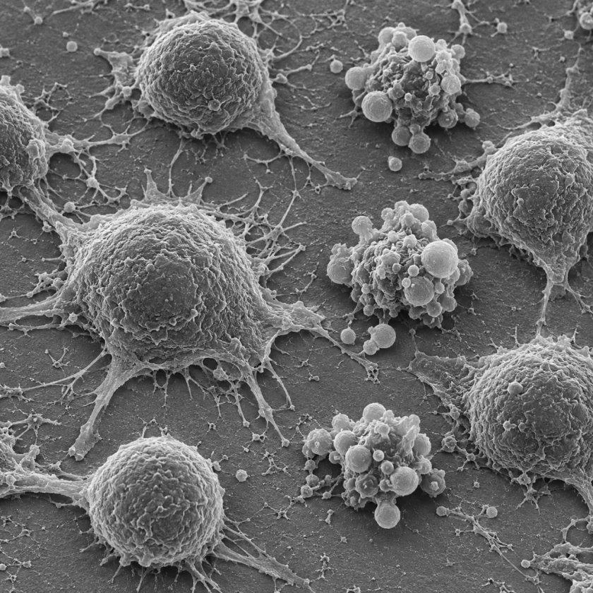 Electron micrograph style image of cultured cells, some shrinking in apoptosis