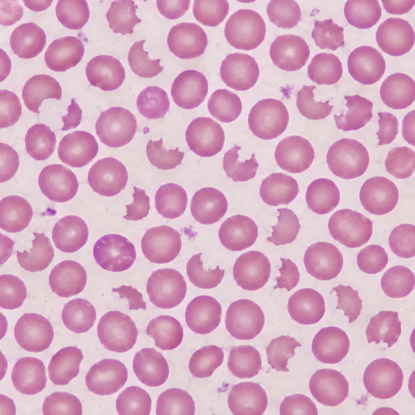 Microscope image of a blood smear with some damaged, fragmented red blood cells