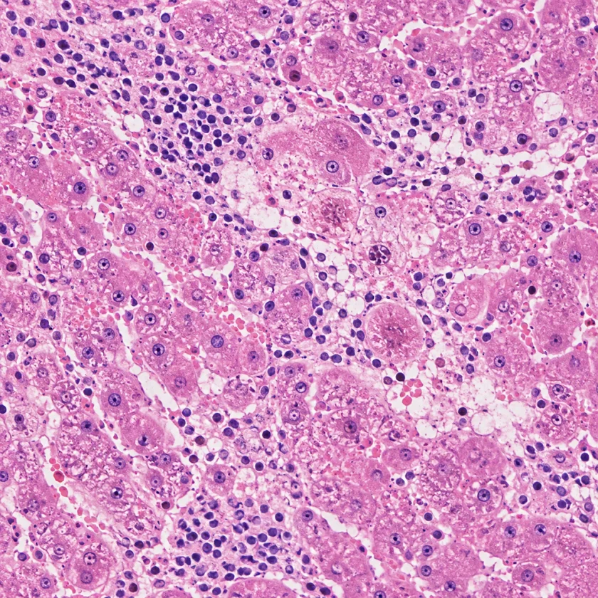 Liver inflammation of the kind seen in the noni case reports