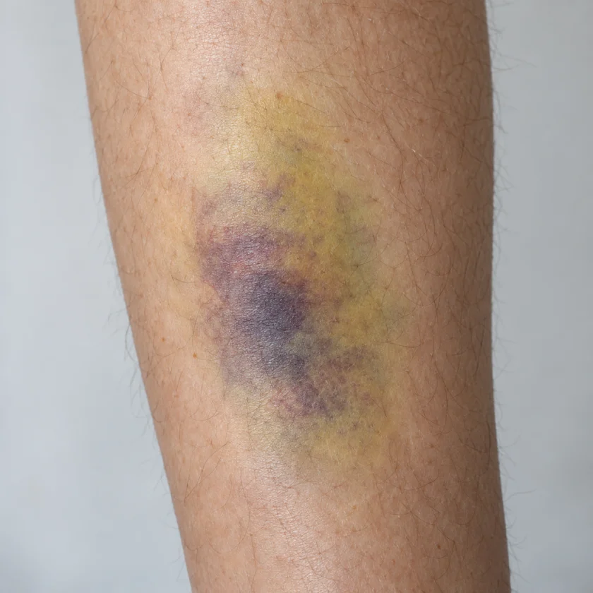 A healing bruise, the classic topical use for arnica