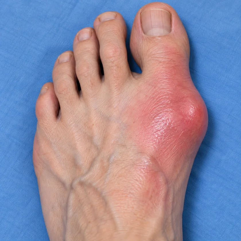 A gout flare at the big toe joint