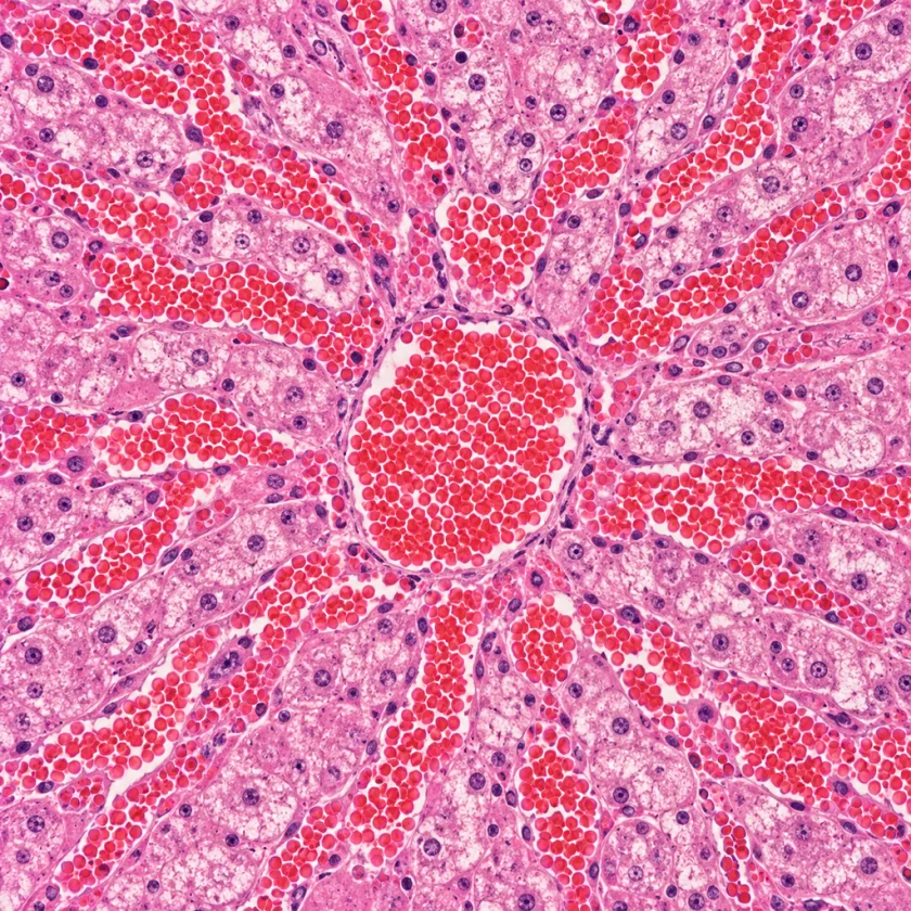 Liver injury from pyrrolizidine alkaloids