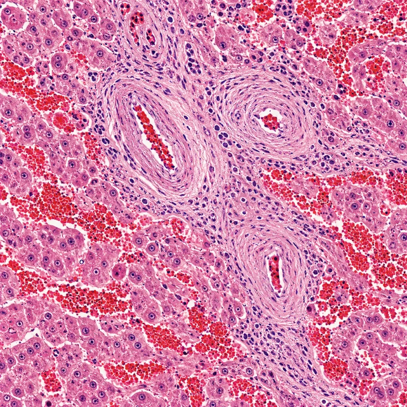 Liver damaged by blocked small veins