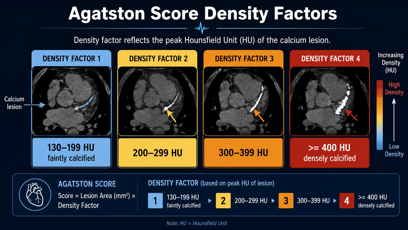 Agatston score density-factor 1 to 4 (130-199 HU through >=400 HU)