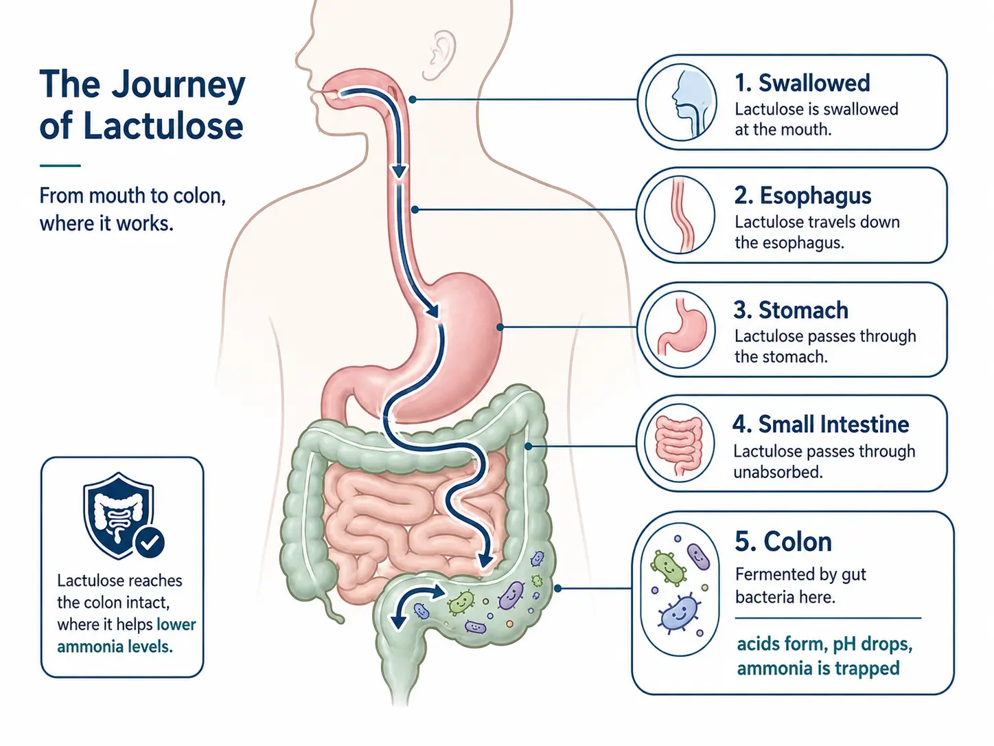 Anatomical illustration of lactulose travelling from the mouth through the stomach and small intestine, reaching the colon where it is fermented