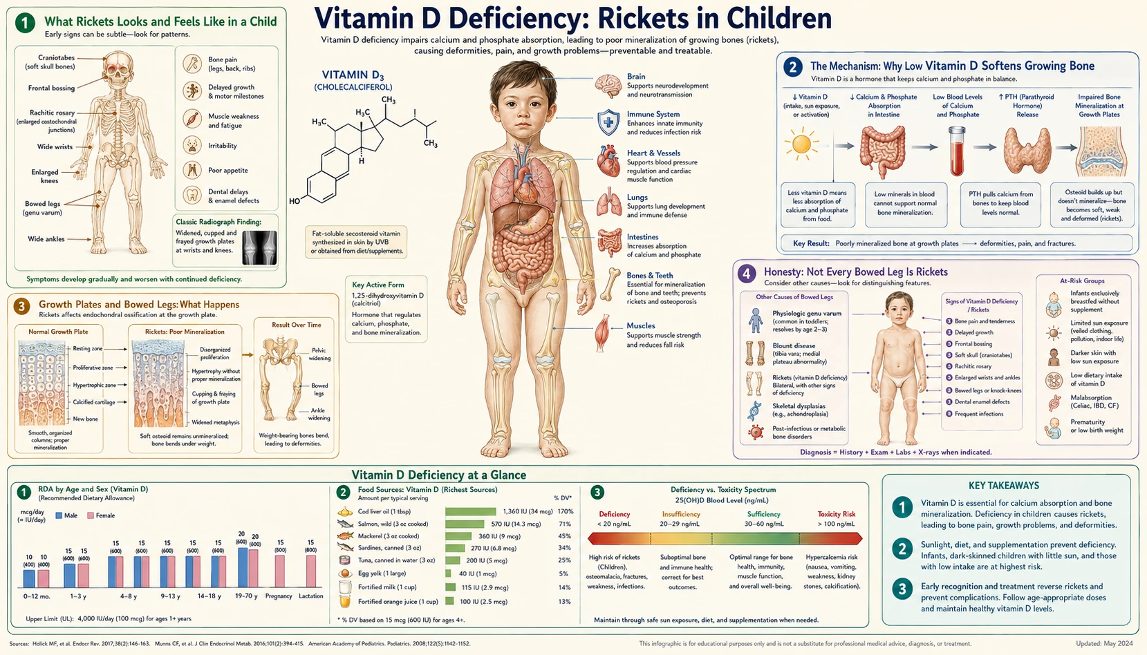 Rickets in Children — scientific infographic poster